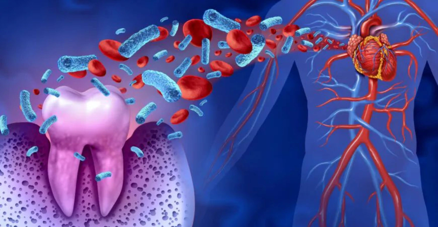 How common is endocarditis from tooth infection